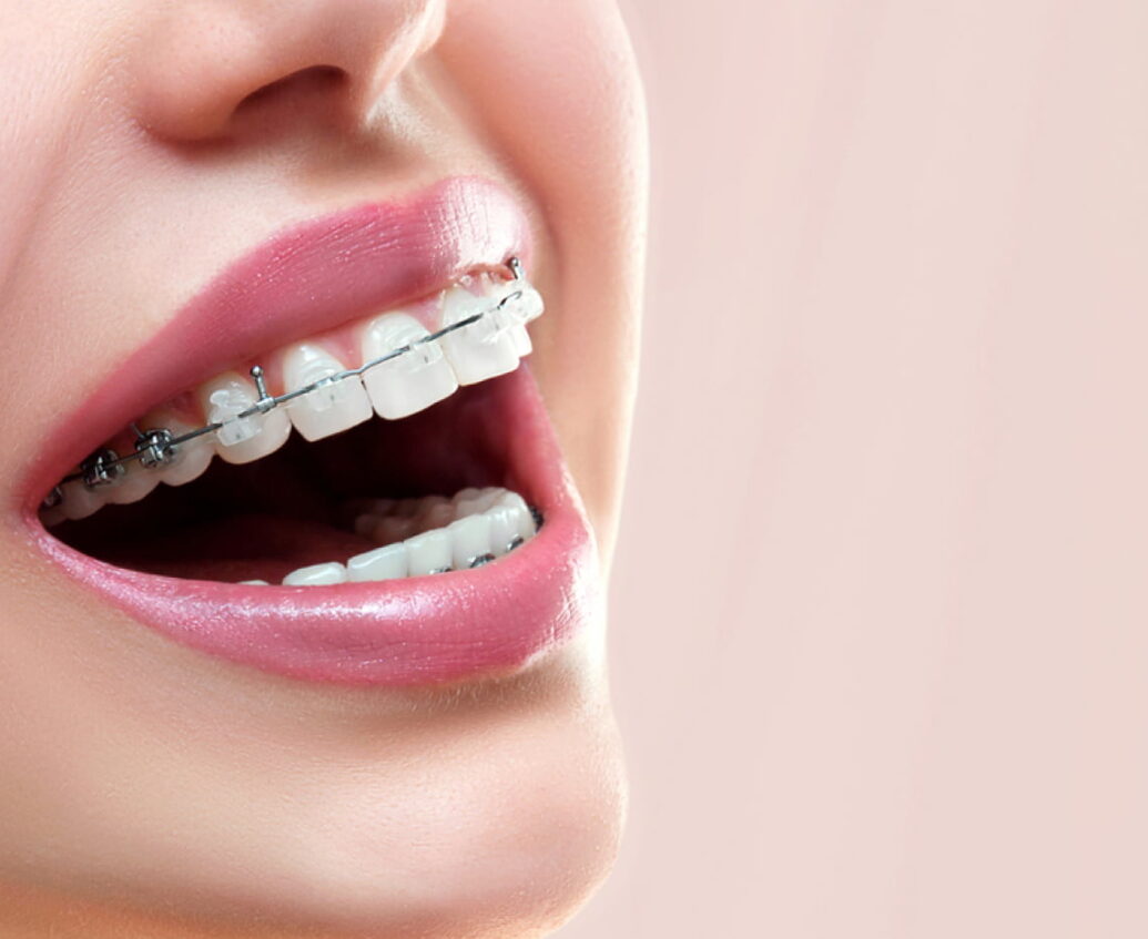 Invisalign